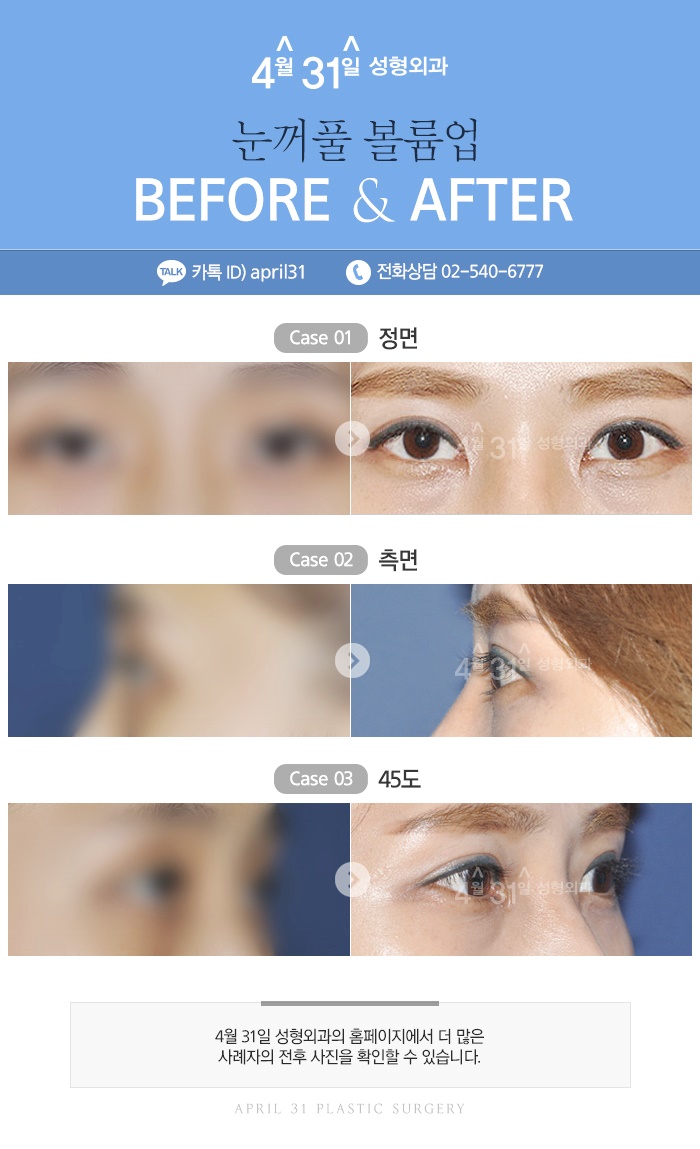 눈지방재배치 알아보자 4월31일성형외과 관련 이미지 6