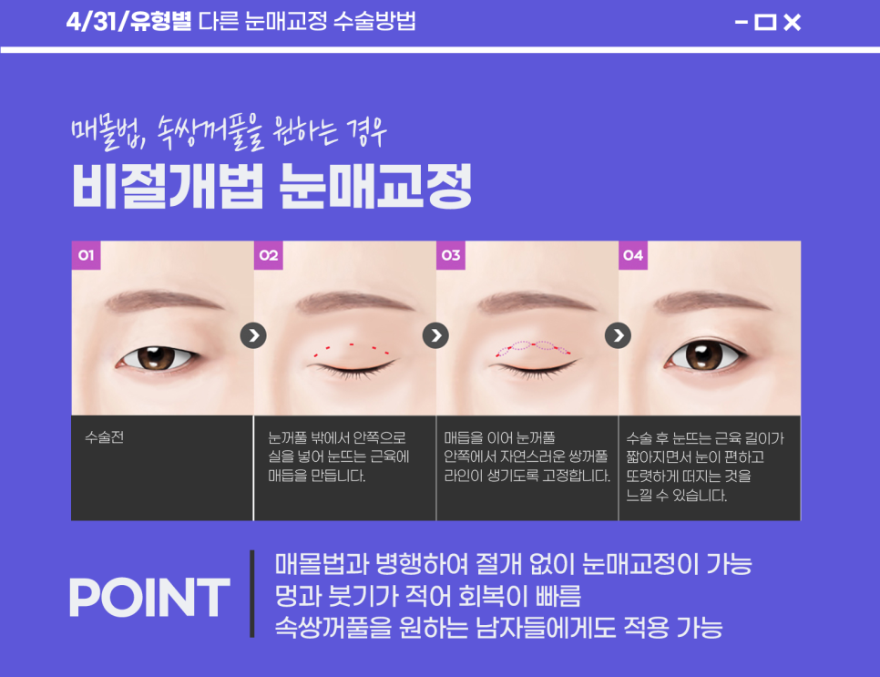 Recommended Hospital for Eye Shape Correction: Say Goodbye to Sleepy Eyes! image 3