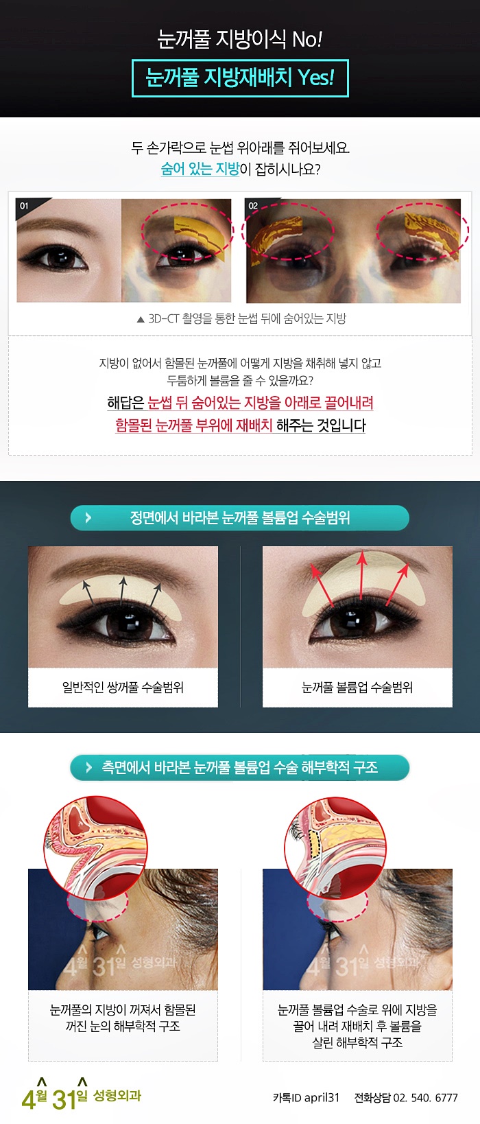 눈꺼풀볼륨업 4월31일성형외과에서 개선하자! 관련 이미지 3
