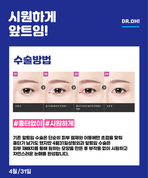 내게 꼭 맞는 눈트임수술 4월31성형외과 트윈클 트임 관련 이미지 3
