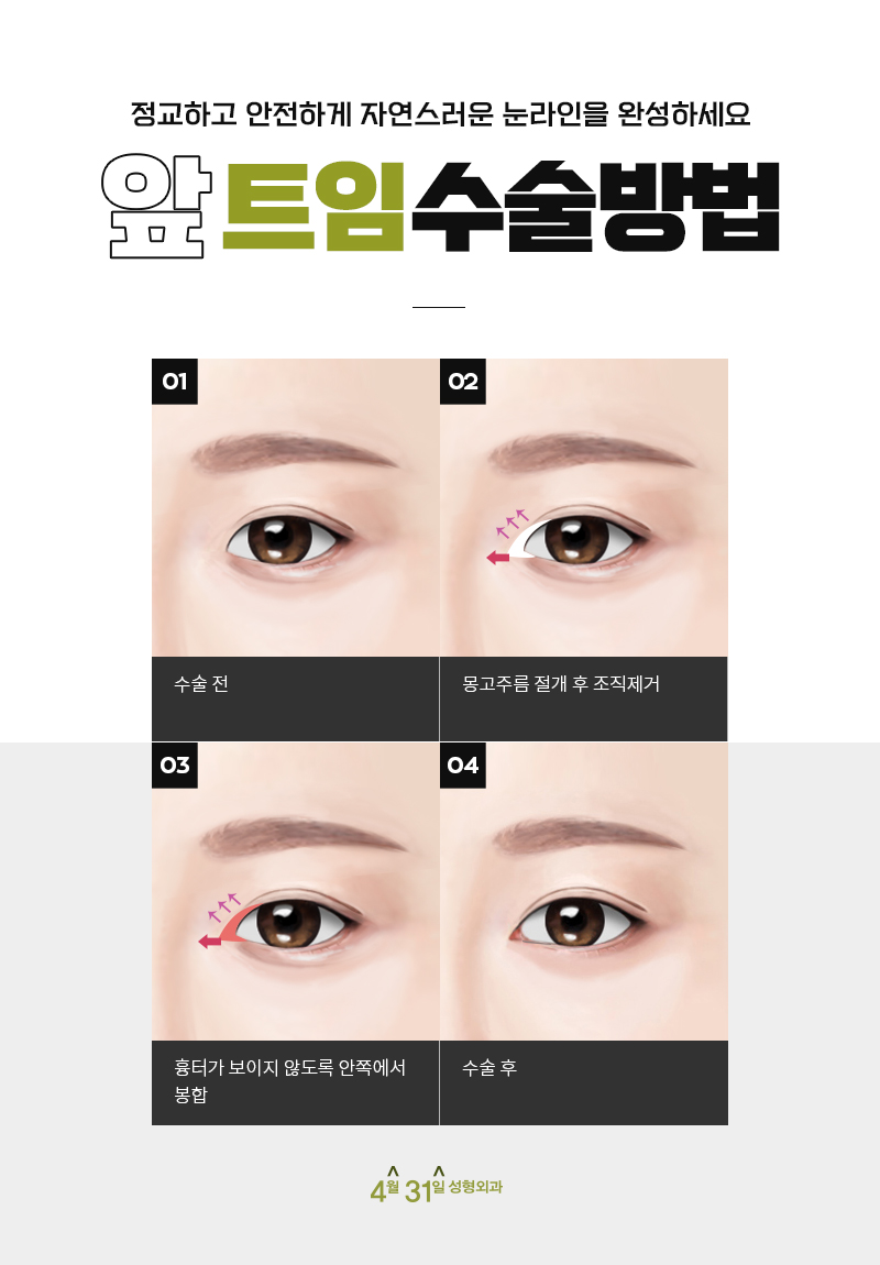 앞트임성형 답답함을 없애요 관련 이미지 4