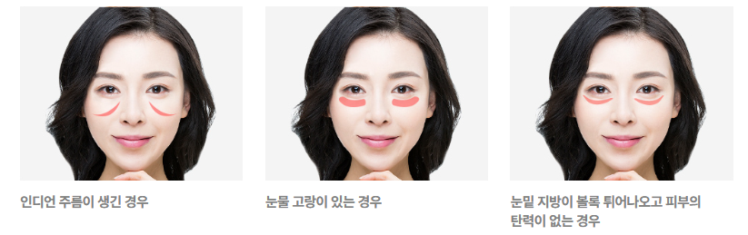 리프팅의 신세계, 4/31 중안면 거상술 관련 이미지 6