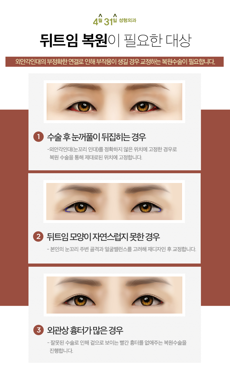 뒤트임복원 더욱 신중하게 관련 이미지 4