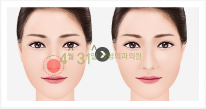 남자코재수술 4월31일성형외과의원에서 자연스럽게! 관련 이미지 7