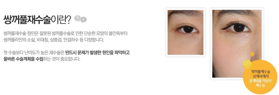눈성형 때문에 고민이신가요? 관련 이미지 6