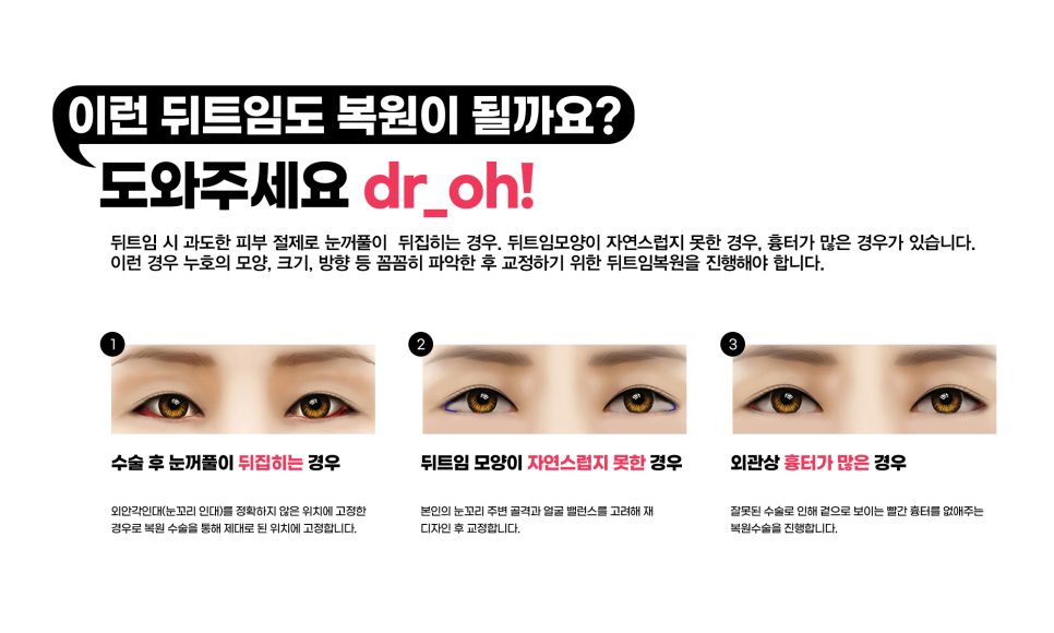 4월31일 Plastic Surgery Clinic: Wrong Epicanthoplasty or Canthoplasty? The Solution Is Right Here! image 5