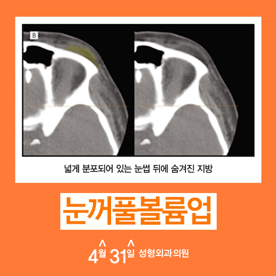꺼진눈꺼풀교정 4월31일성형외과는 어떻게? 관련 이미지 3