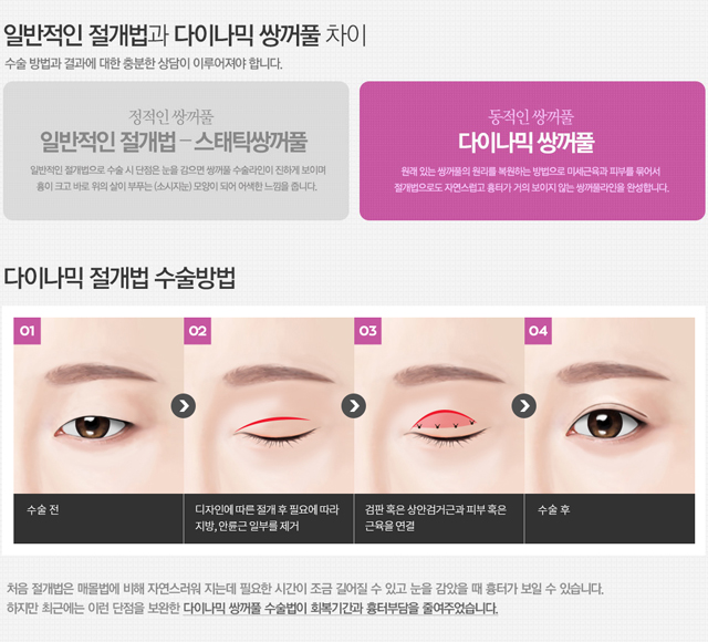 쌍꺼풀절개법 흉터 걱정이라면 4월31일성형외과의원 관련 이미지 2