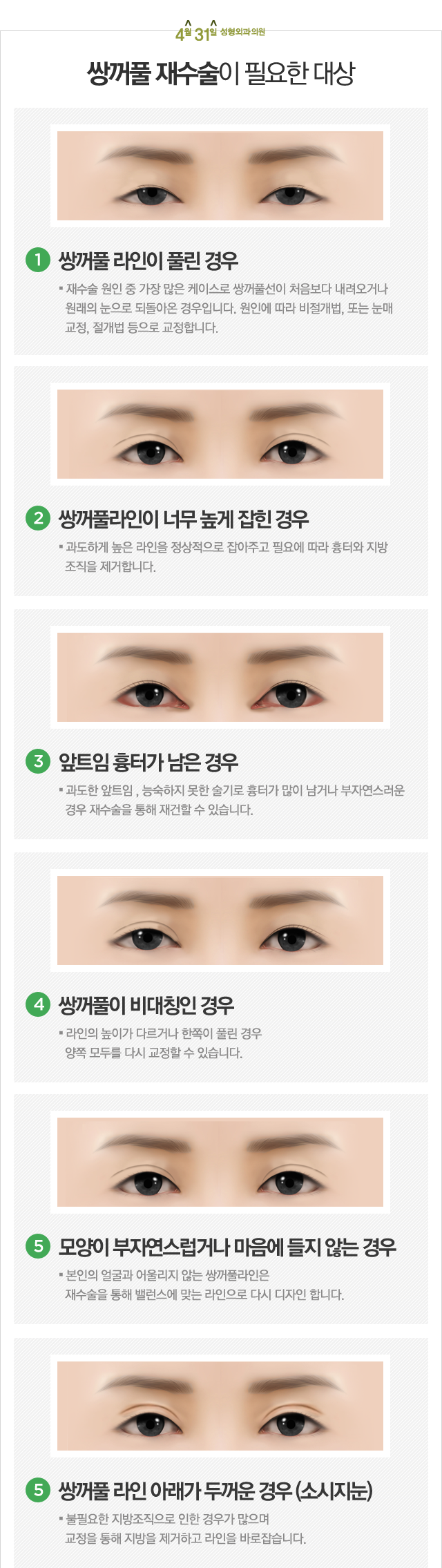 강남눈재수술 하면 4월31일성형외과의원 관련 이미지 1