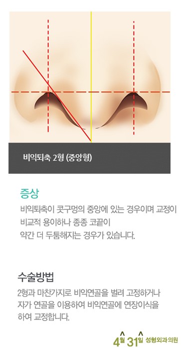 콧구멍수술 비익퇴축술 4월31일성형외과의원 관련 이미지 3