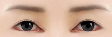 [Eye Revision Surgery] A Difference Made by a Small Detail image 3