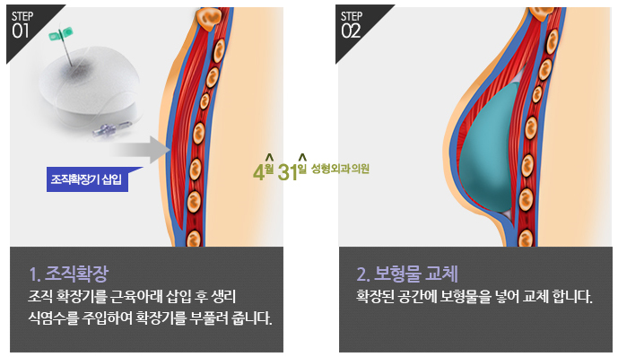유방재건술 자신감 회복은 4월31일성형외과에서 관련 이미지 3