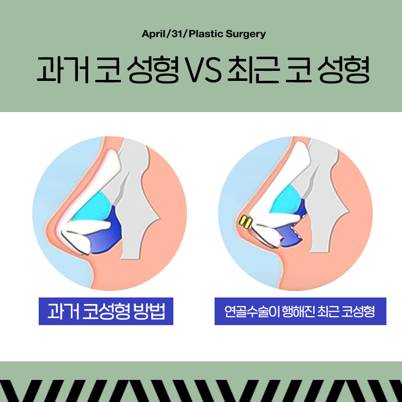 [Contracted Nose] Making the Impossible Possible! Revision Surgery for Contracted Nose image 3