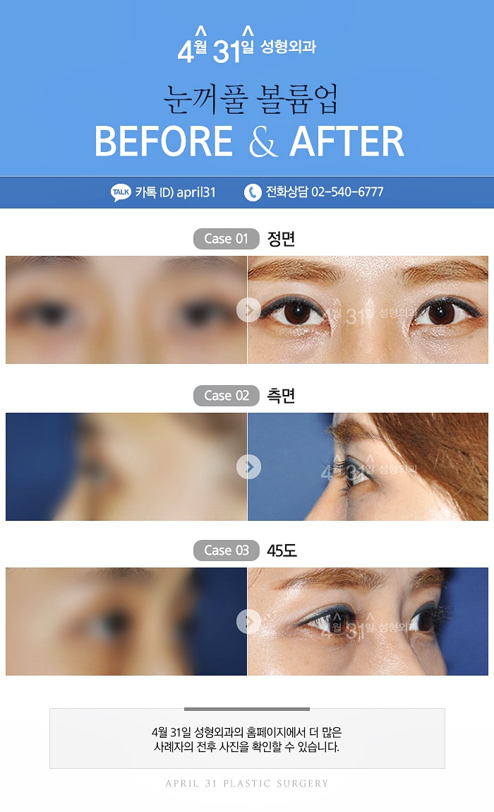 눈꺼풀볼륨업 4월31일성형외과에서 개선하자! 관련 이미지 6