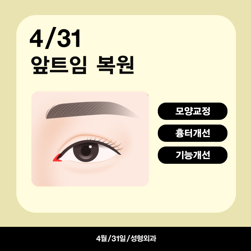 [Eye Revision Surgery] A Difference Made by a Small Detail image 2