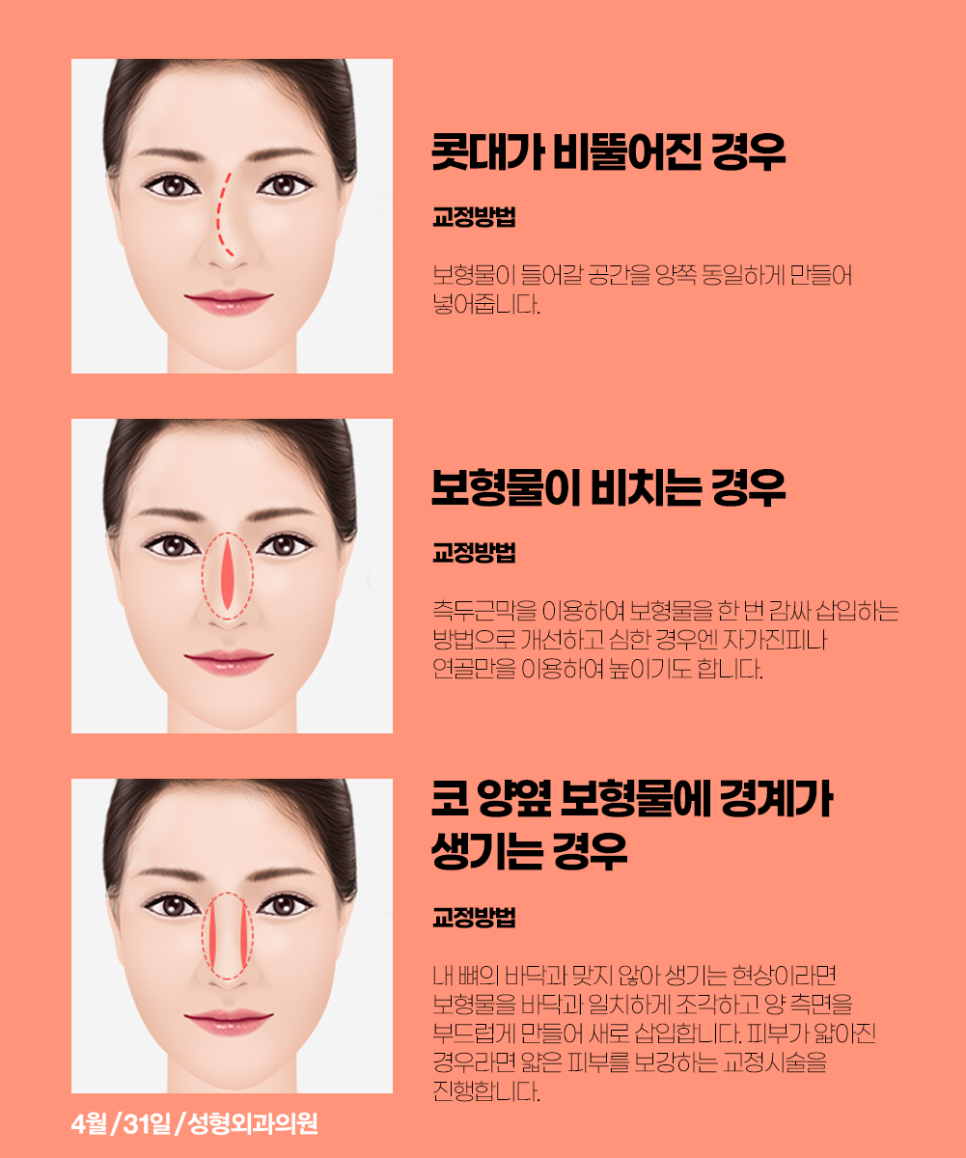 코재수술성형외과추천 마지막코성형은 431에서! 관련 이미지 4