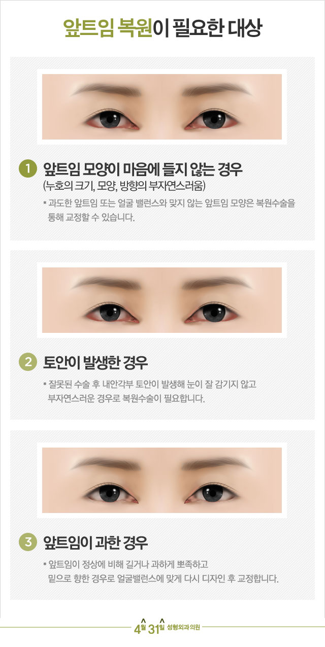 앞트임복원 자연스럽게 4월31일성형외과 관련 이미지 2