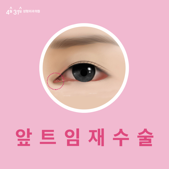 앞트임재건후기 추천병원 4월31일성형외과의원 관련 이미지 1