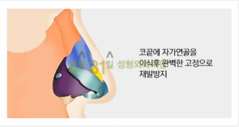 들창코수술 4월31일성형외과의원에서 자연스럽게 관련 이미지 2