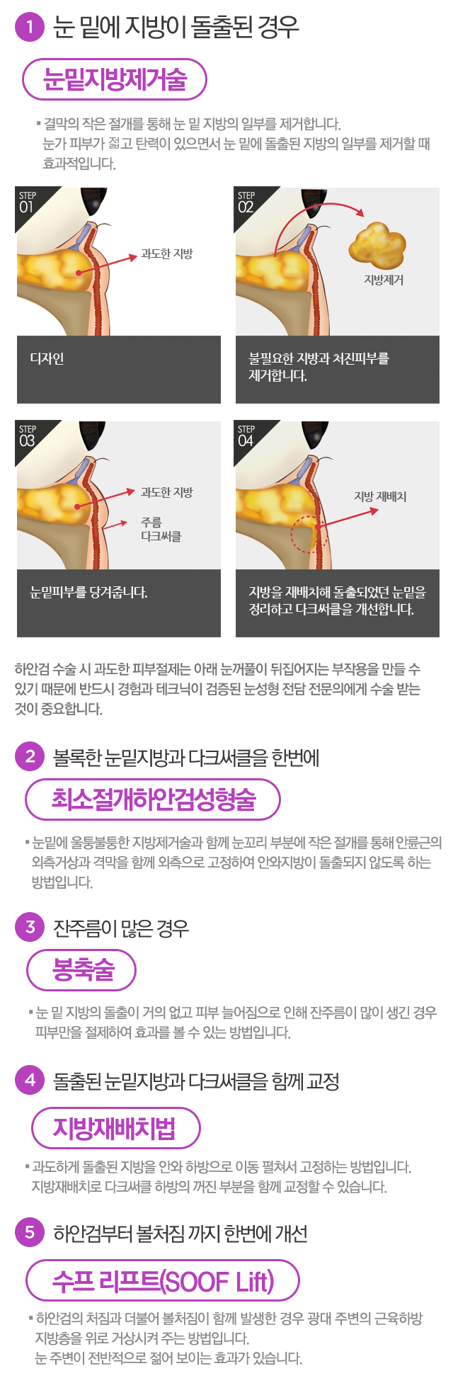 하안검수술회복기간 일주일이면 끝 4월31일성형외과 관련 이미지 3