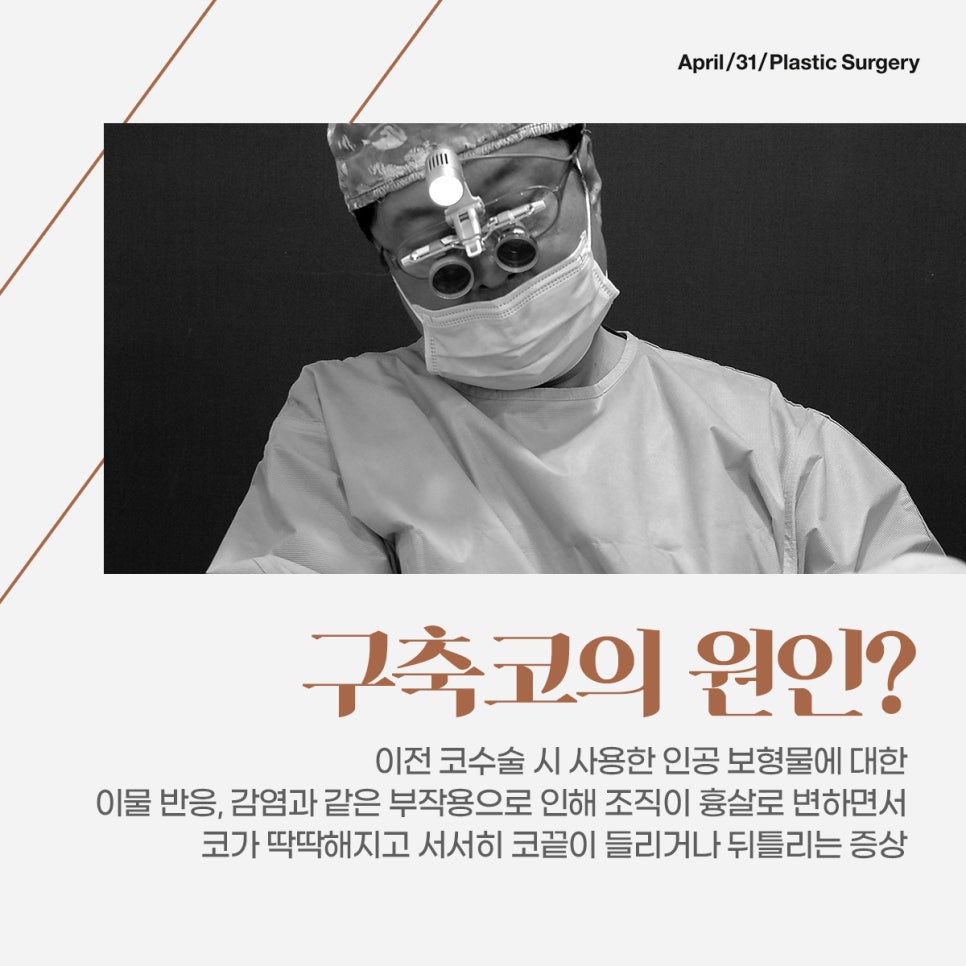A Clinic That Also Considers the Functional Aspects of Contracted Nose Revision Surgery image 2