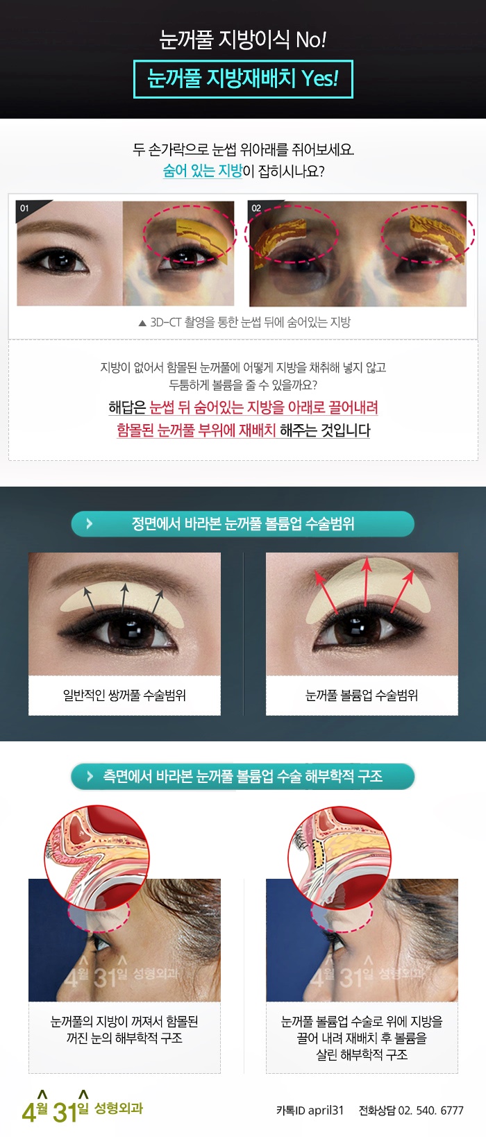 눈꺼풀볼륨업 잘하는곳 4월31일성형외과 관련 이미지 3