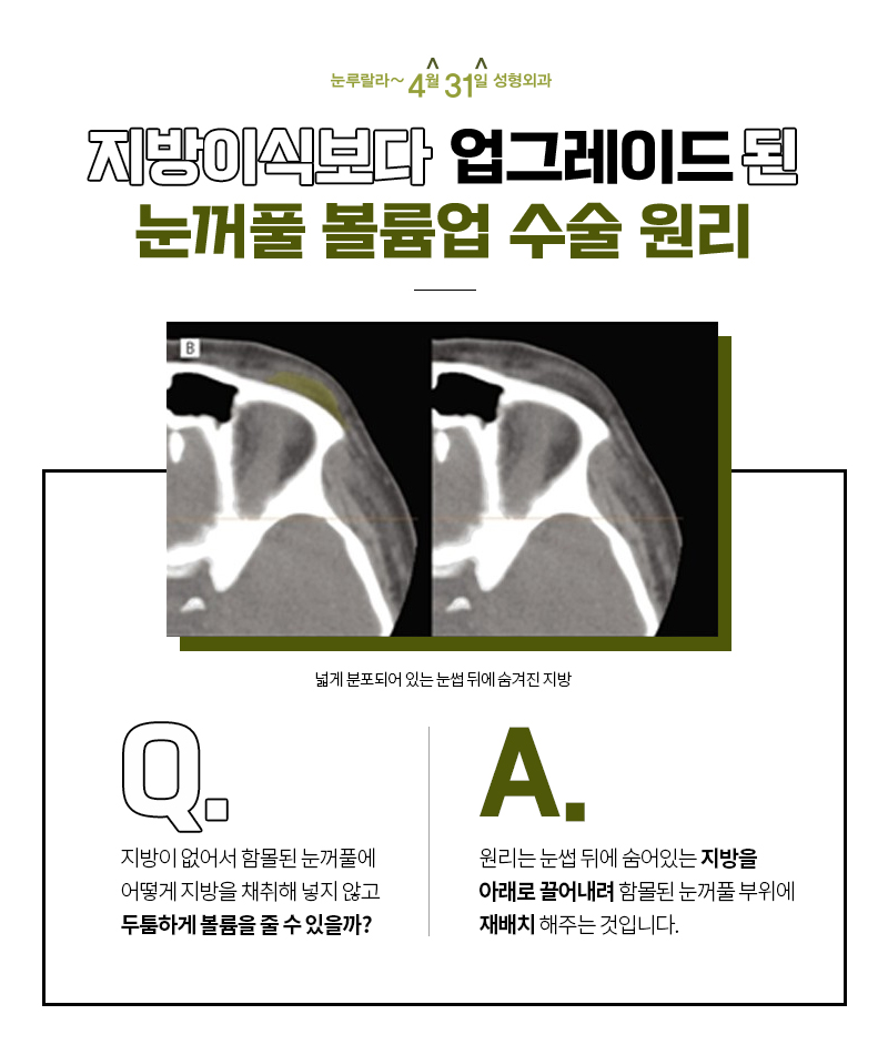 꺼진 눈 교정 지방이식 안전하게 하는 방법 눈꺼풀볼륨업으로!! 관련 이미지 5