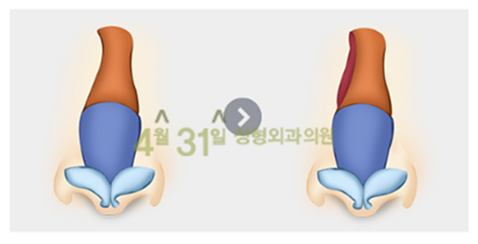 휜코수술비용을 알고싶다면?4월31일성형외과로 관련 이미지 4