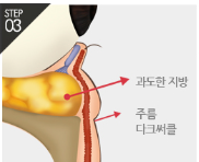 [Eye Plastic Surgery] Middle-Aged Eye Surgery to Improve Uneven Under-Eyes! Lower Blepharoplasty image 6