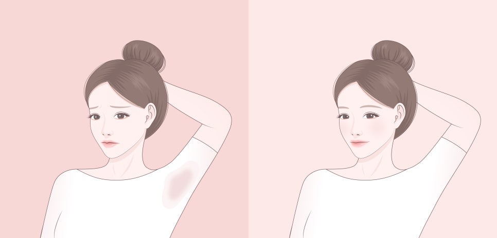 [April 31 Petit Center] Underarm Botox: A Safe Non-Surgical Solution for Hyperhidrosis image 6