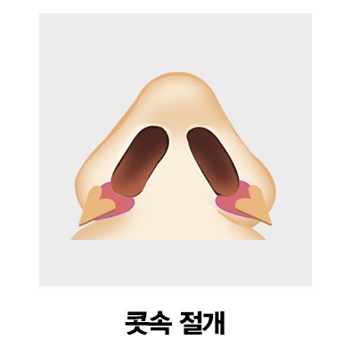 [코성형] 아름다운 코 모양의 완성은? 4/31 콧볼축소수술 관련 이미지 4