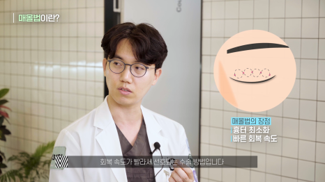 [눈성형] 내눈에는 어떤 방법이 최선일까? (매몰/절개/부분절개) 관련 이미지 3