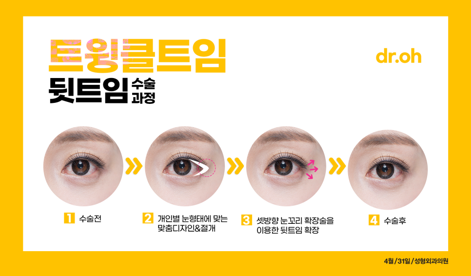 Back Canthoplasty and Lower Canthoplasty Price: If You Want a Bright, Open Eye Shape, Try Twinkle Canthoplasty! image 4
