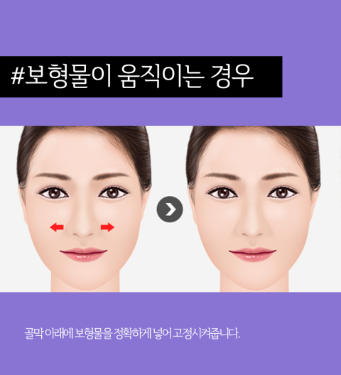 The Difference Between Experience and Skill! April 31 Plastic Surgery, Specialist in Nose Revision Surgery image 3