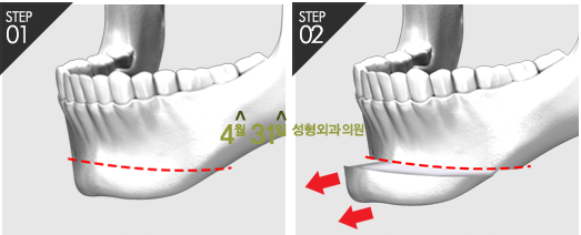 무턱수술후기 만족스러운 이유! 관련 이미지 3