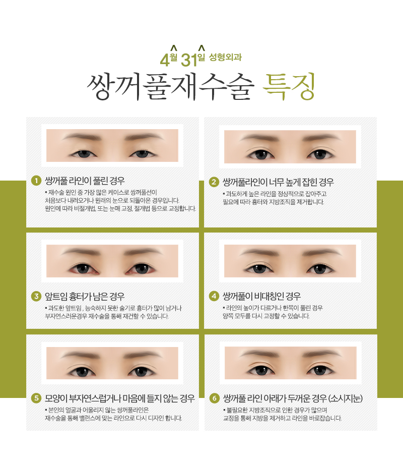 쌍꺼풀재수술가격 적당한곳이란 관련 이미지 3