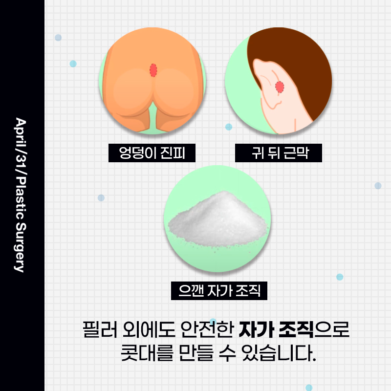 [Nose Surgery] Rhinoplasty Is Possible Without Implants image 4