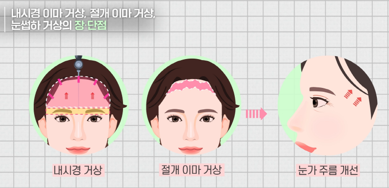 [Facelift Surgery] Endoscopic Forehead Lift or Brow Lift: Which Case Am I? image 8