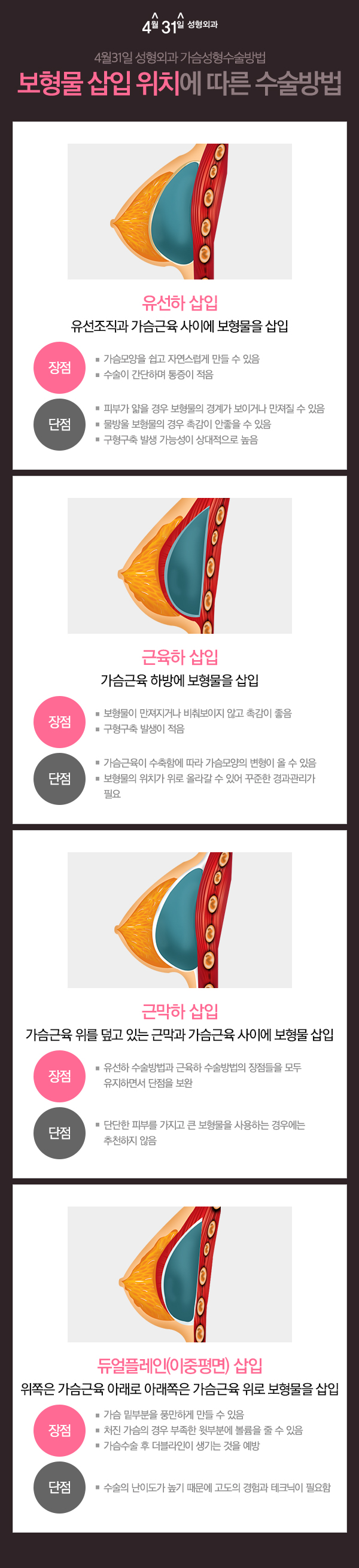 가슴수술구형구축 부담 줄인 4월31일성형외과의원 관련 이미지 3