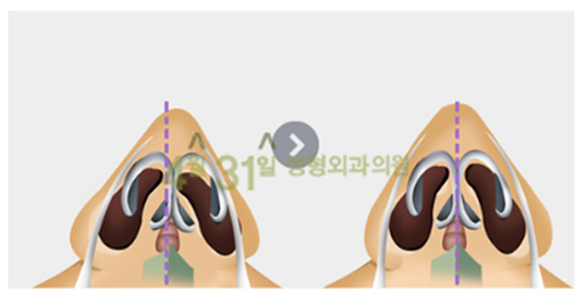 휜코수술비용을 알고싶다면?4월31일성형외과로 관련 이미지 5