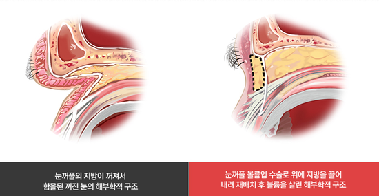 들어간눈성형 4월31일성형외과의원에서 관련 이미지 2
