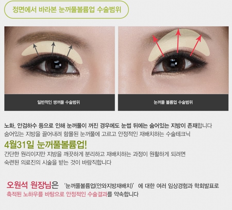 눈꺼풀볼륨업 신뢰할 수 있는 곳! 관련 이미지 4