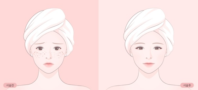 Complete the Fight Against Melasma and Spots with a Pigmentation Treatment Solution! (Pico Toning / Pico Fraxel / Carbon Peeling) image 6