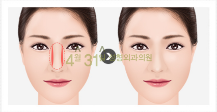 남자코재수술 4월31일성형외과의원에서 자연스럽게! 관련 이미지 5