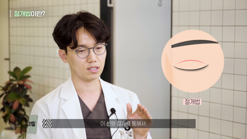 [눈성형] 내눈에는 어떤 방법이 최선일까? (매몰/절개/부분절개) 관련 이미지 4