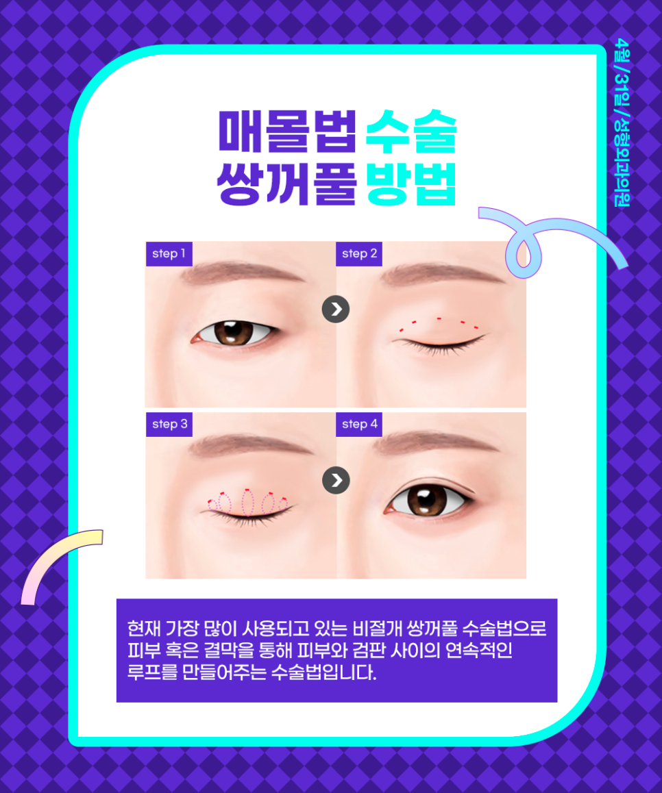 Find Your Lifelong Line with a Director Who Has Over 22 Years of Experience at a Hospital That Specializes in Double Eyelid Surgery image 4