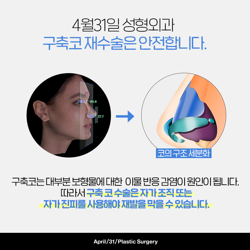 [Contracted Nose] Making the Impossible Possible! Revision Surgery for Contracted Nose image 2