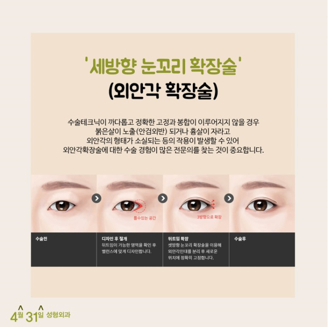 뒤트임 붙지 않는 4월31일성형외과의 비결 관련 이미지 3