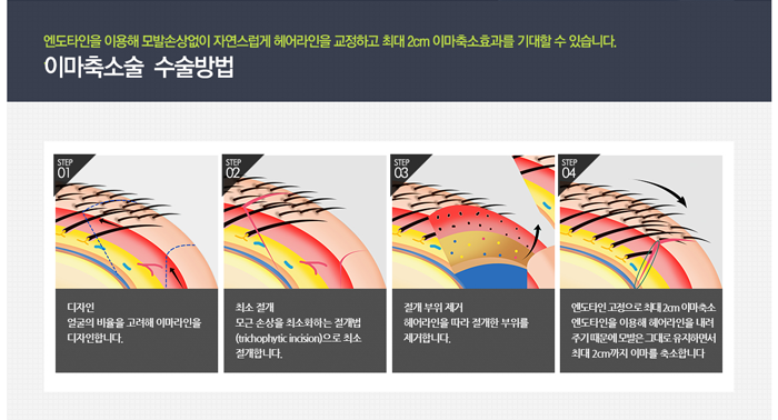 이마축소술 4월31일성형외과에서 흉터 걱정 없이 관련 이미지 4