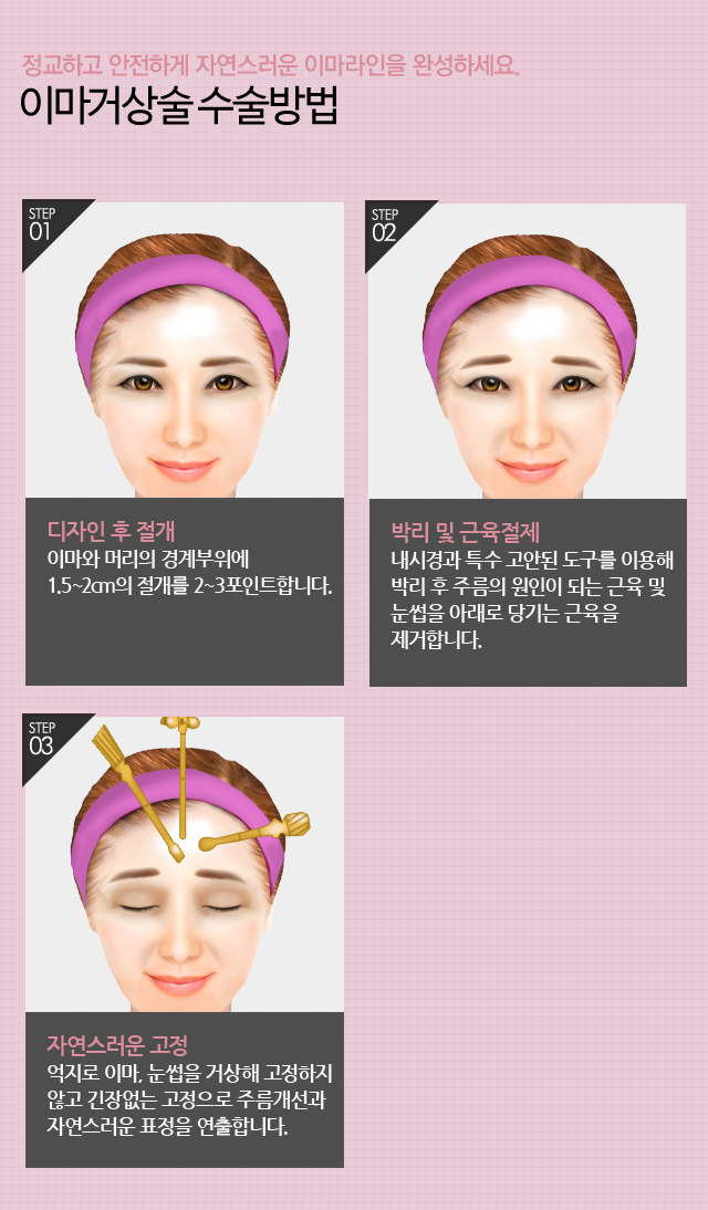 내시경이마거상술 잘하는곳 4월31일성형외과 관련 이미지 3